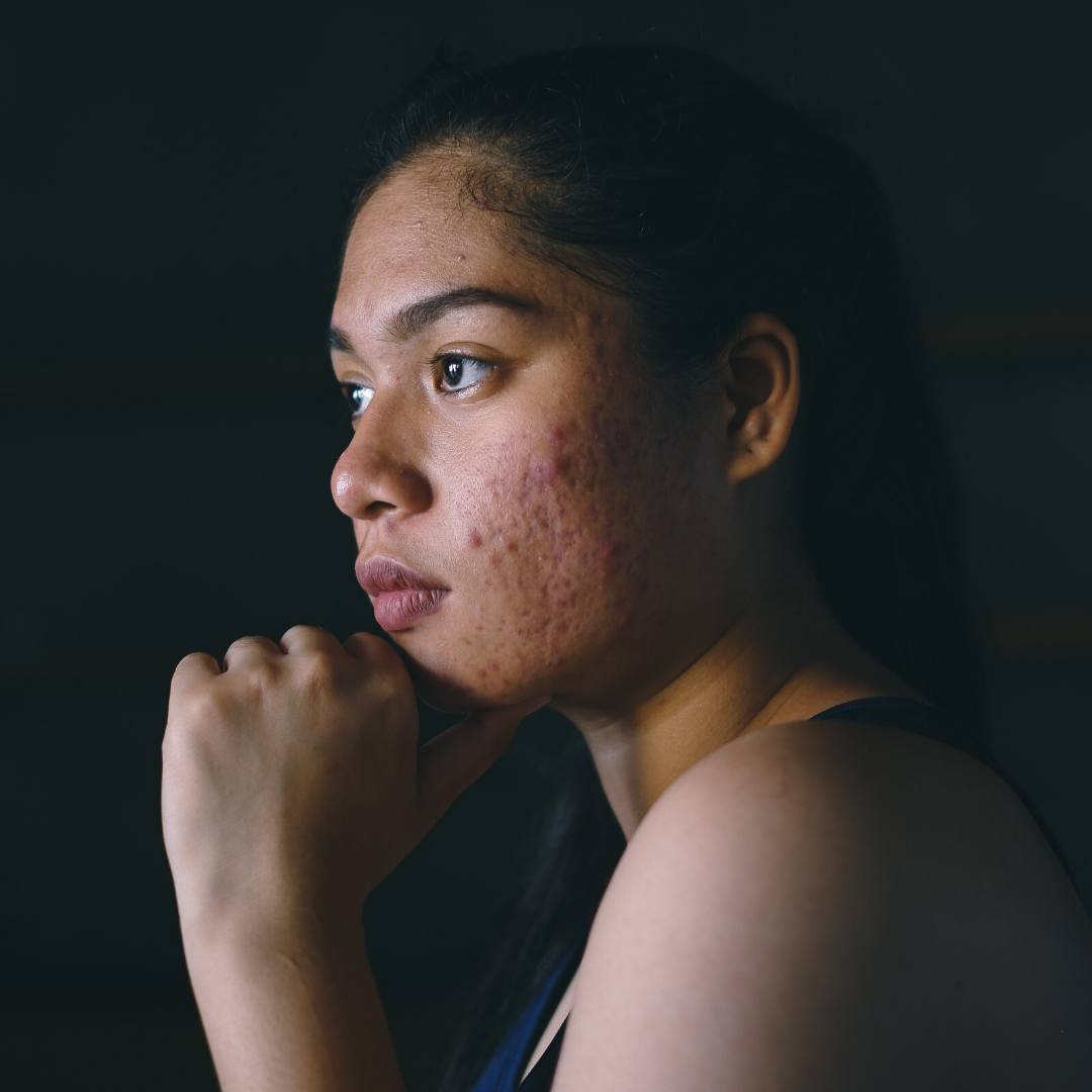Acne Awareness