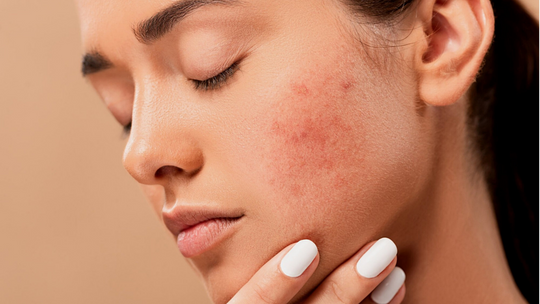 What Are The Key Ingredients For Effective Acne Treatments?