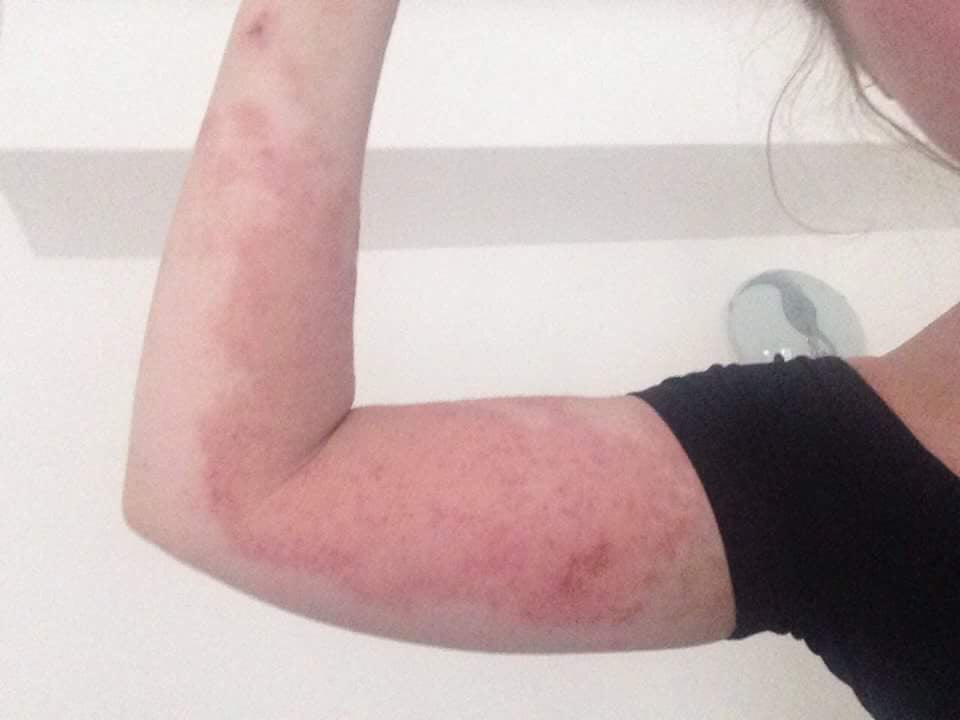 National Eczema Week