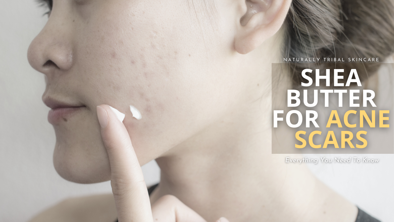 Shea Butter for Acne Scars - Everything You Need to Know