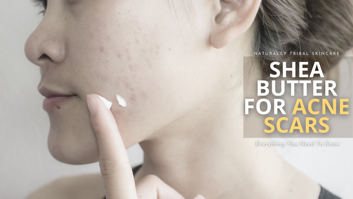 Shea Butter for Acne Scars - Everything You Need to Know