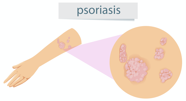 Psoriasis Awareness