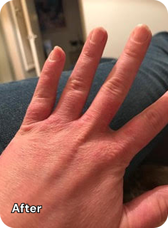 Hand After