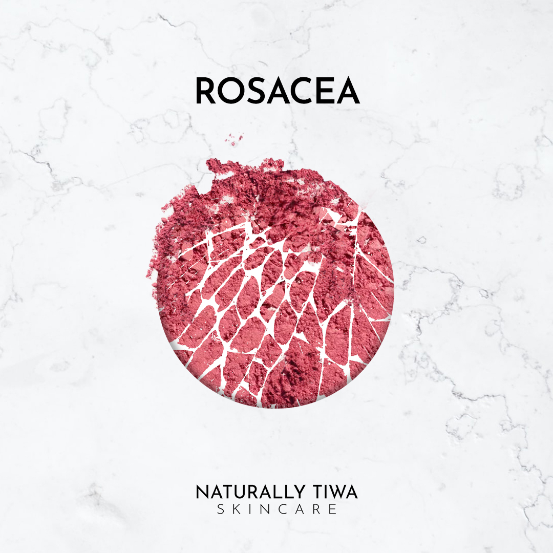 Naturally Tiwa Skincare IYA Body Food 90ml sensitive skin, eczema, psoriasis, rosacea, skin undergoing chemotherapy and radiotherapy and dry skin conditions.