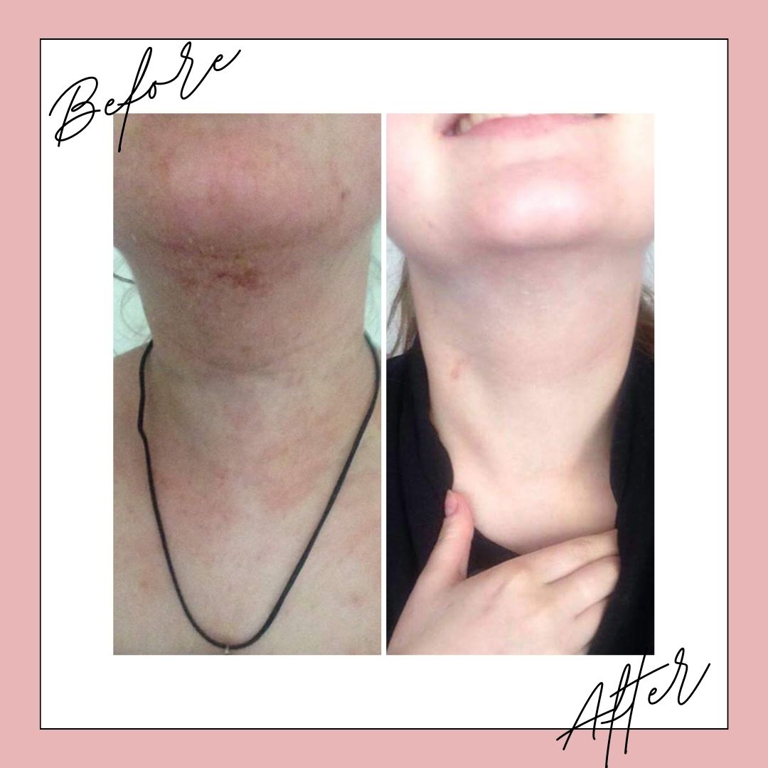 Naturally Tiwa Skincare IYA Body Food 90ml sensitive skin, eczema, psoriasis, rosacea, skin undergoing chemotherapy and radiotherapy and dry skin conditions.