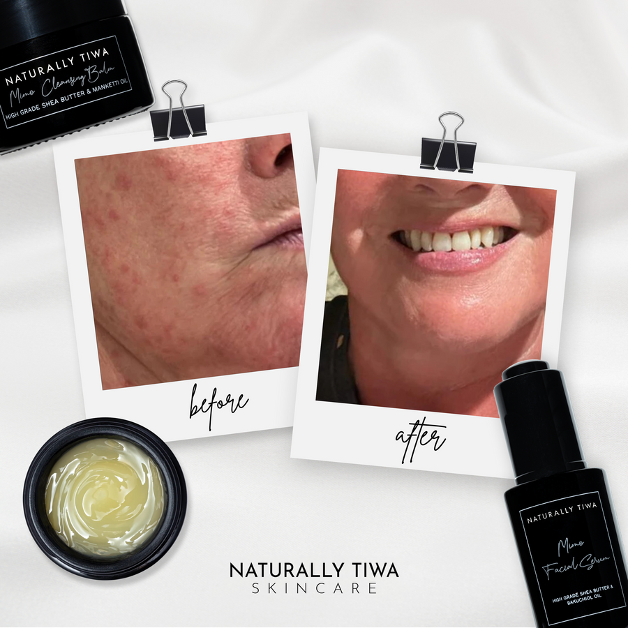 Naturally Tiwa Skincare MIMO Facial Serum sensitive skin, eczema, psoriasis, acne, hyperpigmentation, skin undergoing chemotherapy and radiotherapy and dry skin conditions.