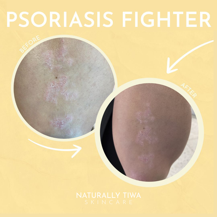Naturally Tiwa Skincare OKA Body Polish eczema, psoriasis, acne, skin undergoing chemotherapy and radiotherapy, dry skin conditions, Keratosis Pilaris