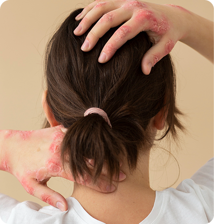 Psoriasis Skin Scalp - Naturally Tiwa Skincare