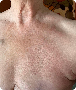 Real Skin after - Naturally Tiwa Skincare