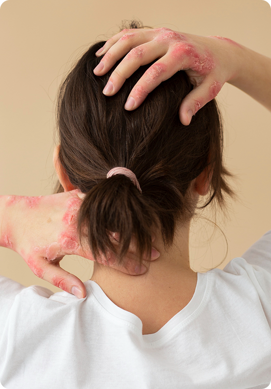 Skin Conditions