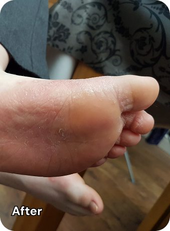 foot after