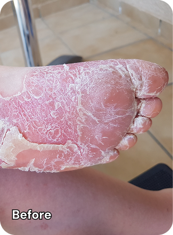foot before