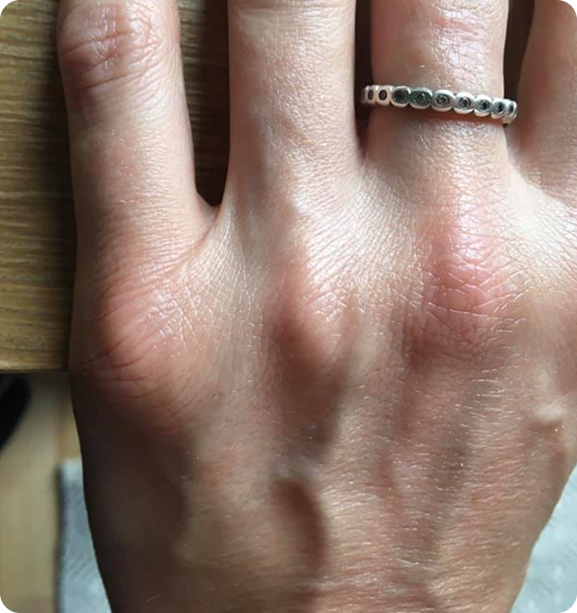 Hand skin after treatment