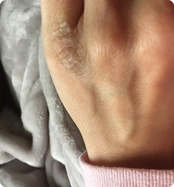 Hand skin before treatment