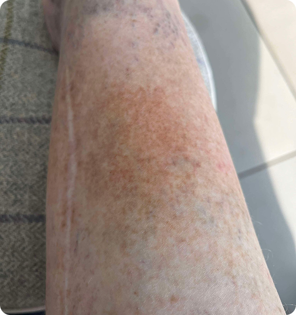 After skin transformation treatment