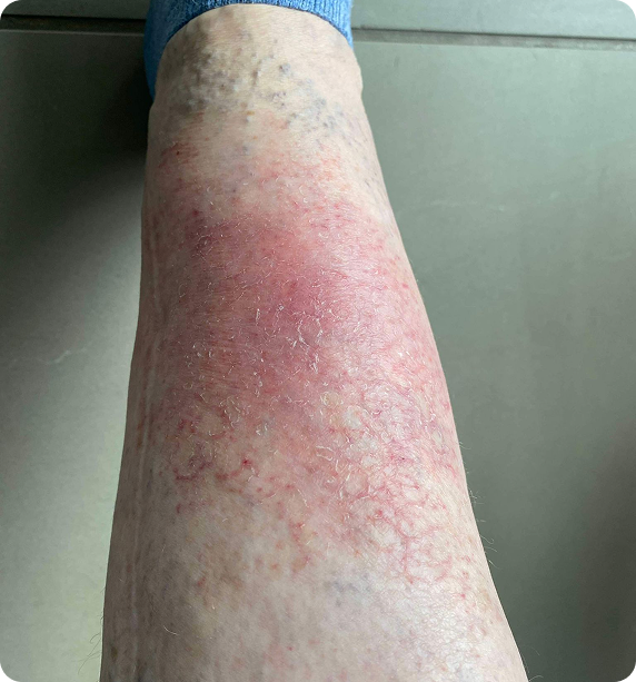 Before skin transformation treatment